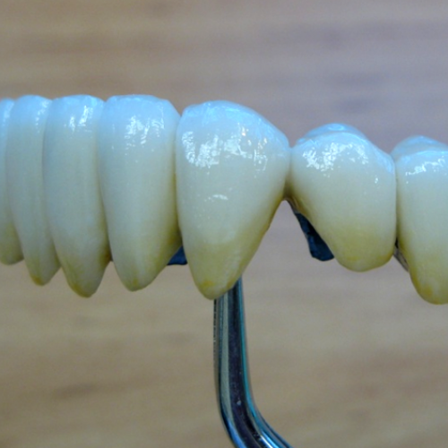 3  LP dental-keramický můstek-keramika NORITAKE ノリタケ.png