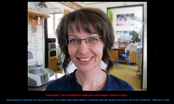11 Zhotovení kopie náhrady,která byla  vyrobena podle vzhledu úsměvu před úrazem..jpg