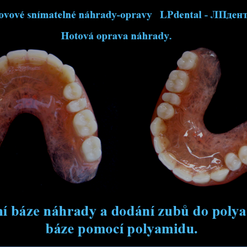 16  Dodání zubů a rozšíření báze pomocí polyamidu..png