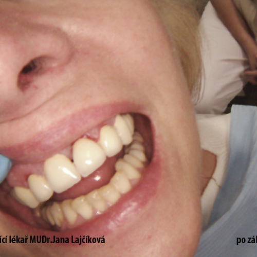 4  MUDr.Jana Lajčíková-Petr Moj- LPdental-keramika NORITAKE ノリタケ.png