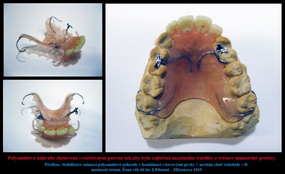 3 Předkus. Stabilizace snímací polyamidové náhrady v kombinaci s kovovými prvky
