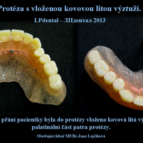 1 Litá výztuž-Snímatelné náhrady z Deflexu kombinace polyamid-kov