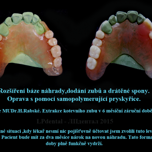 8 Oprava samopolymerující pryskyřicí-rozšíření báze-dodání zubů a drátěné spony...png