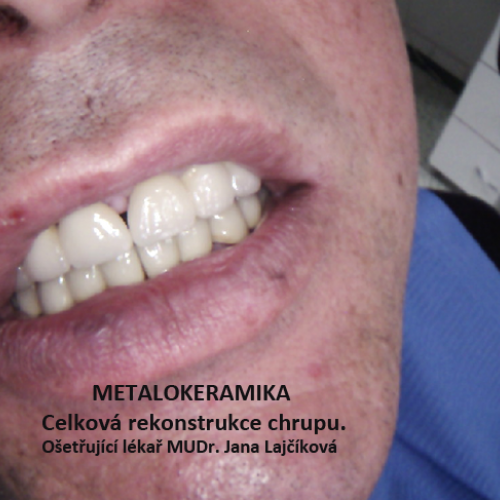 35 MUDr.Jana Lajčíková-Petr Moj-LPdental-keramika.png