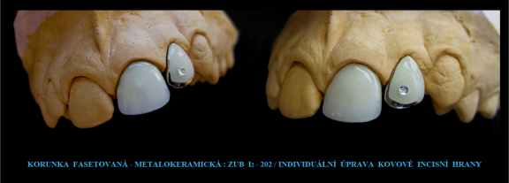 1 Korunka fasetovaná-metalokeramická.png