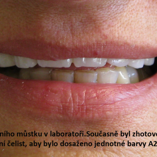 3 provizorní můstek z plastu.png