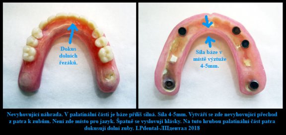 Horní celková hybridní náhrada-fixace systém Locator -Nevyhovující náhrada 1.jpg