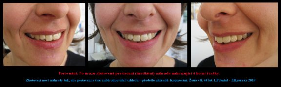 9 Zhotovení kopie náhrady,která byla  vyrobena podle vzhledu úsměvu před úrazem..jpg