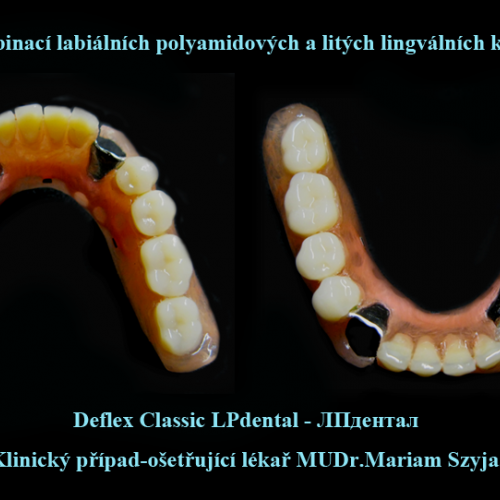 2 Lité spony-Snímatelné náhrady z Deflexu kombinace polyamid-kov.png