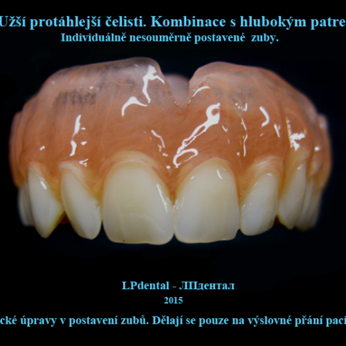 18-32 Bezkovová snímatelná náhrada z Deflexu..png