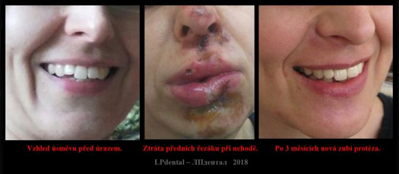 10 porovnání výsledku foto před úrazem-úraz-nová zubní náhrada..jpg