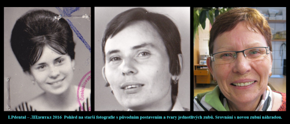1 Protruze (Protrusion) zhotovení protézy podle starší fotografie s původním postavením zubů..png