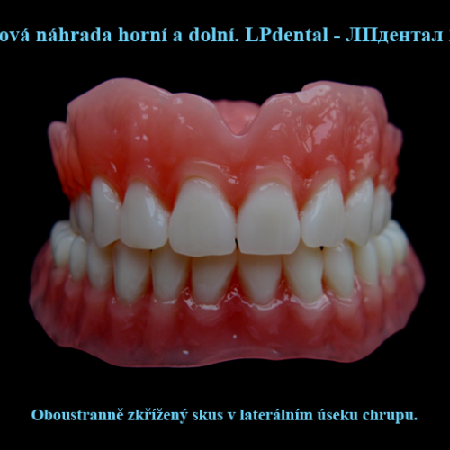 23 Oboustranně zkřížený skus v laterálním úseku chrupu..png
