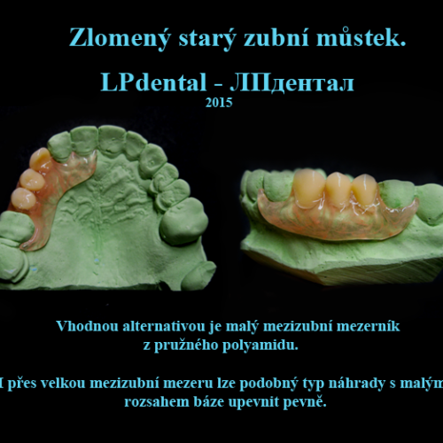 03-15 Bezkovová snímatelná náhrada z Deflexu.png.png