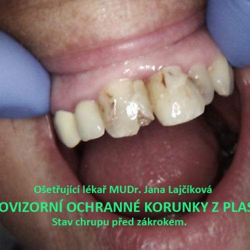 12 Provizorní ochranné korunky z plastu..png