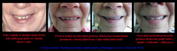 1 Protéza nedrží. Nepřirozeně mění vzhled úsměvu. Přikusuji si s ní ret. Žena věk 79.jpg