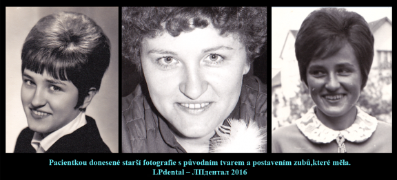 1 Pohled na původní postavení a tvar zubů pacientky na starších fotografiích..png