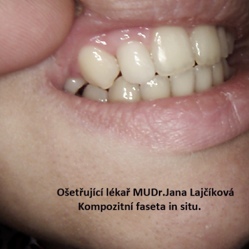 5 Estetická faseta z kompozitního plastu.png