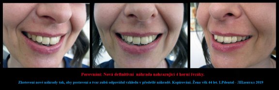 10 Zhotovení kopie náhrady,která byla  vyrobena podle vzhledu úsměvu před úrazem..jpg