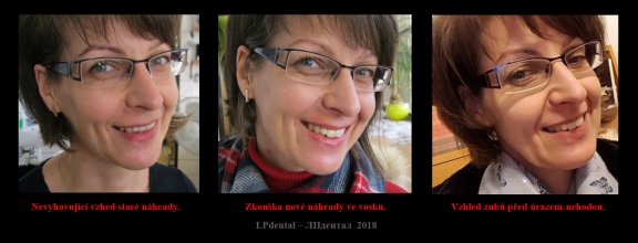 4 zkouška nové náhrady-porovnání s esteticky nevyhovující a stevem před-.jpg