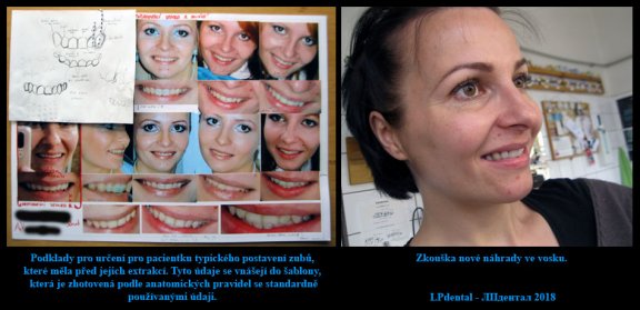 Horní celková hybridní náhrada-fixace systém Locator -idividualizace skusové šablony 12.jpg