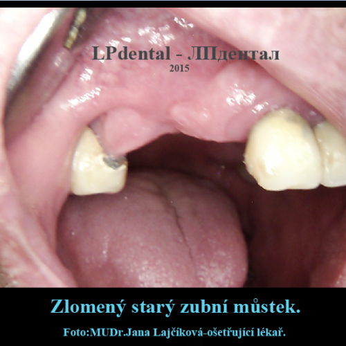 03-13 Bezkovová snímatelná náhrada z Deflexu.png.png