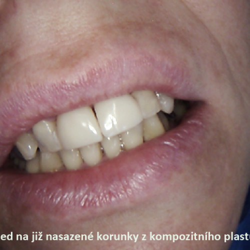 11 Korunky a fasety z kompozitního plastu..png