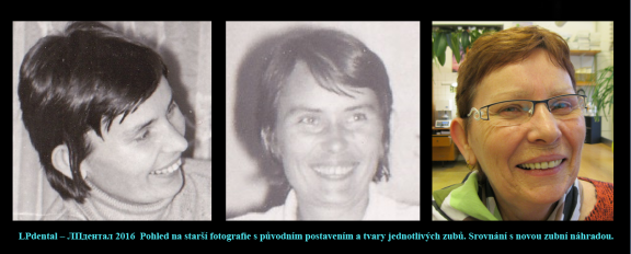 2 Protruze (Protrusion) zhotovení protézy podle starší fotografie s původním postavením zubů..png