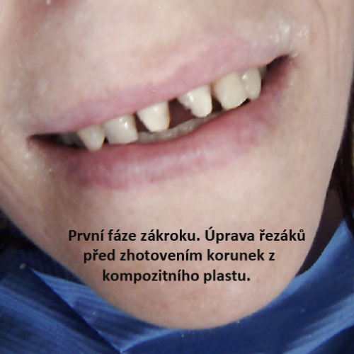 10 Korunky a fasety z kompozitního plastu..png