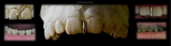 5 Dentální ozdoby-zlato-LPdental.png