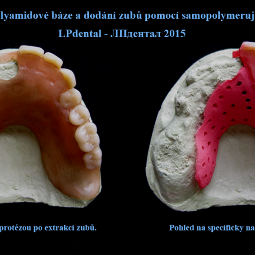 28 Rozšíření polyamidové báze a dodání zubů pomocí  samopolymerující pryskyřice..png