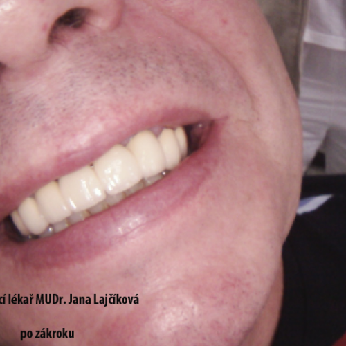 17  MUDr.Jana Lajčíková-Petr Moj- LPdental-keramika NORITAKE ノリタケ.png