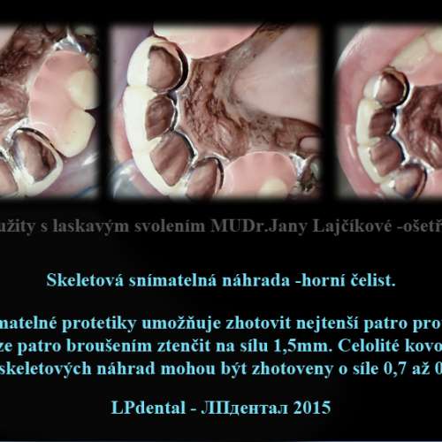 05-2 Skeletová snímatelná náhrada-horní čelist.png