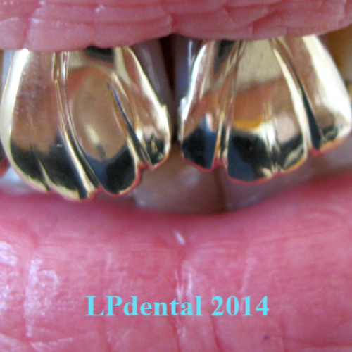 21 Grillz-individuální výrobek.png