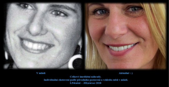 3 Celkové imediátní náhrady. Individuální zhotovení podle původního postavení a vzhledu zubů..jpg
