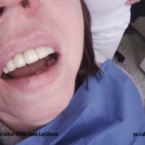 21  MUDr.Jana Lajčíková-Petr Moj- LPdental-keramika NORITAKE ノリタケ.png