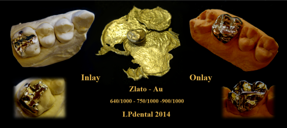 1 Inlej-Inlay-Onlej-Onlay-Zlato-Gold.png